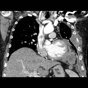 Coronal contrast enhanced CT of the thorax shows a large lobulated soft tissue mass within the left lower hemithorax which invades the diaphragm to enter the abdomen. Also note the large soft tissue mass which invades the left lateral fifth rib. 