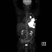Maximum intensity projection (MIP) of an F18 FDG-PET/CT scan shows the large left hemithorax mass which has marked FDG uptake. Multiple other lesions with avid uptake are seen, concerning for metastatic disease. 