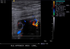 Transverse ultrasound image of the right lower quadrant of this patient's abdomen with color doppler shows a dilated tubular structure with increased surrounding vascularity. Additionally, free fluid is seen. 