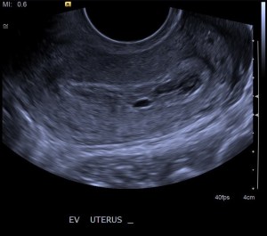Ectopic Pregnancy (pseduogestational sac sign): Sagittal endovaginal ultrasound image of the uterus shows a hypoechoic fluid collection in the endometrial cavity.