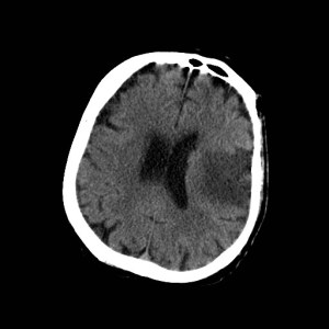 Single axial CT of the head without contrast reveals a well defined region of hypoattenuation in the left insular cortex with adjacent sulcal effacement and mass effect as evidenced by bulging into the left lateral ventricle