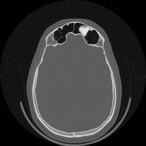 Single axial CT of the head without contrast shows a well defined, calcified mass within the left frontal sinus. 