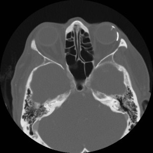 Single axial CT scan of the head in bone windows shows a glaucoma drainage device along the left lateral globe, with a drainage tube entering the anterior chamber of the left eye