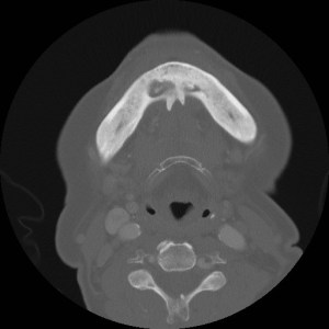 Fig 2: Single axial CT scan of the mandible in bone windows in the same patient 2 years later shows marked progression of sclerosis of the mandible with interval sequestrum formation. Additionally (not shown), there was fistulization to the oral cavity.