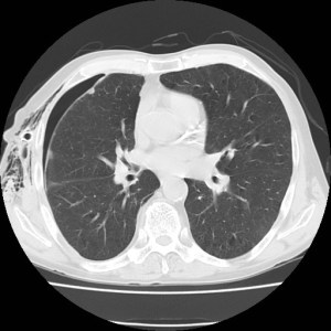 Single axial CT scan in lung windows shows the patient is status post right sided chest tube patient with right chest wall soft tissue emphysema. A small pneumothorax is present with nodularity evident along the right visceral pleura.