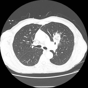 Fig 1: Single axial CT scan of the chest in lung windows shows a mass in the medial left upper lobe extending towards the left hilum. 