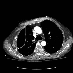 Fig 2: Single axial CT scan of the chest  with IV contrast in the same patient shows a metallic valve within a segmental bronchus, which has been placed to help treat the bronchopleural fistula. 