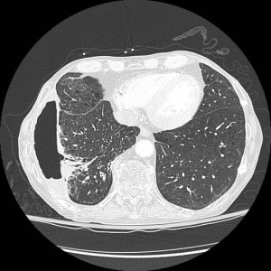 Fig 1: Single axial CT scan in lung windows shows a large right sided hydropneumothorax with apparent communication with a bronchus in an area of scarring and traction bronchiectasis, worrisome for bronchopleural fistula. 