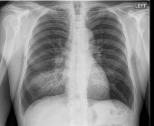 Fig 1: Single frontal upright chest radiograph shows discrete ground glass opacity with consolidation in the right middle lobe