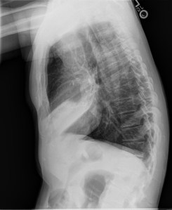 Fig 2: Left lateral chest radiograph in the same patient shows marked consolidation of the right middle lobe, anterior and superior to the right oblique fissure