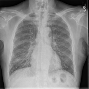 Frontal radiograph of the chest demonstrates marked interlobular septal thickening with septal lines (Kerley B lines) in the lung periphery. Also, while this patient's cardiac silhouette does not appear markedly enlarged, it was enlarged compared to an old exam 5 years prior.