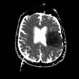 ADC map in the same patient shows decreased signal (restricted diffusion) in the corresponding region of increased DWI signal.