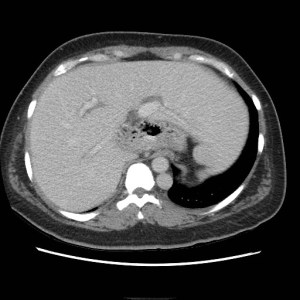 Single axial CT scan of the abdomen with contrast shows a large left sided IVC posterior to the aorta at the level of the diaphragmatic crura. 