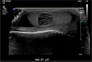 Ultrasound image through the right testicle shows a well circumscribed heterogeneously hypoechoic mass. 