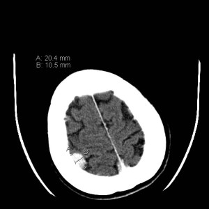 Single axial CT scan through the head without contrast shows a right parietal extra-axial mass which is calcified