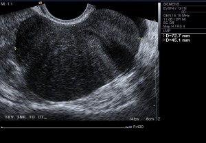 Transverse ultrasound image through the pelvis at a level inferior to the uterus shows a large 7.3 cm by 4.5 cm homogeneously hypoechoic mass.