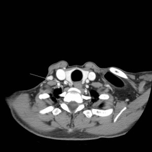 Single axial contrast enhanced CT through the neck at the level of the thyroid gland reveals an enhancing nodule posterior to the inferior right thyroid lobe. 