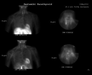 Tc-99m-Sestamibi scan showing a focus of increased radiotracer activity in the region of the inferior right thyroid gland, both on the immediate images and the 2 hour delayed images. This is compatible with a parathyroid adenoma, given the history of hypercalcemia.