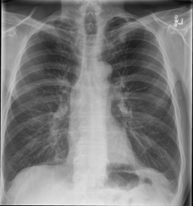 Single frontal chest radiograph shows a solitary nodule in the left mid lung containing coarse "popcorn" calcifications. 