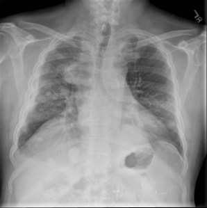 Single frontal radiograph shows multiple scattered nodules throughout the lungs. Additionally, one large confluent retrocardiac opaque mass is seen, as well as a medial right upper lung mass. 