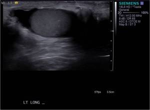 Ultrasound through the left testicle shows a well circumscribed isoechoic mass arising from the scrotum inferior to the left testicle. 