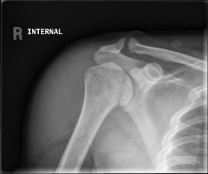 AP radiograph of the right shoulder with internal rotation of the humerus reveals cystic degenerative changes involving the humeral head and acromioclavicular joint. Additionally, the humeral head has an abnormal morphology.