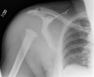 Follow up AP radiograph of the shoulder in the same patient only five months later shows complete destruction of the humeral head with a cut off appearance of the proximal humerus, as well as destruction of the glenoid.