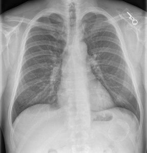 Frontal radiograph of the chest reveals normal lungs and heart. Incidentally, a round mass with eggshell calcification is seen projecting over the left upper quadrant of the abdomen.