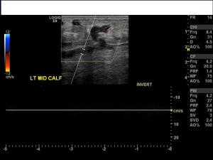 Ultrasound image of the left mid calf with color doppler shows multiple dilated veins which fail to compress and contain internal echogenic clot. Additionally, no internal flow is present.