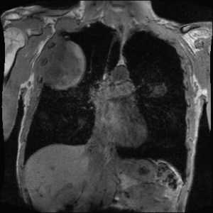 T1W coronal MR image of the chest reveals a large heterogeneous T1 isointense mass in the right lateral chest wall, invading the intercostal muscles and compressing the right upper lobe of the lung. 