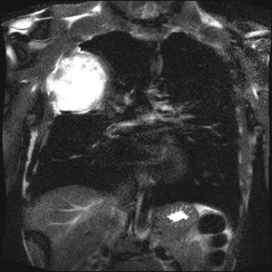 T2 weighted MR image of the chest shows marked T2 hyperintensity of the mass, with a more easily defined component extending through the lateral chest wall.