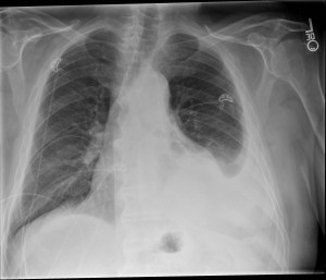 Single frontal chest radiograph demonstrates a moderate sized left pleural effusion, enlarged cardiac silhouette and possible left lower lung consolidation.