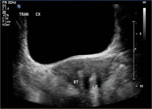 Transverse ultrasound through the pelvis in the same patient at a more inferior section shows two separate cervices, defining this abnormality as a uterine didelphys.