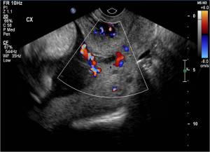 Sagittal ultrasound image through the cervix with color doppler flow shows velamentous cord insertion with vasa previa.