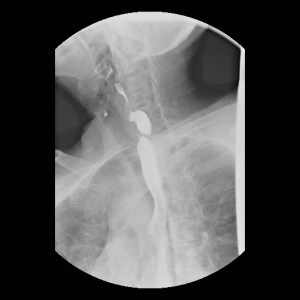 Lateral oblique image of the esophagus with dual contrast (barium and air) reveals a posterior outpouching of the esophagus filling with barium. 