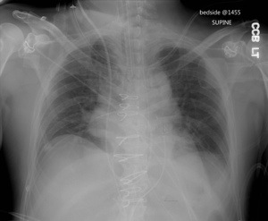 Frontal chest radiograph reveals multiple lines and tubes (see below for explanation). Multiple median sternotomy wires are present and surgical clips are seen projecting over the mediastinum. 