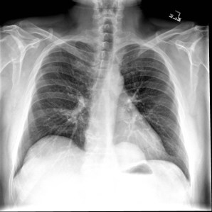 Frontal radiograph of the chest reveals a well defined retrocardiac opacity (arrow).