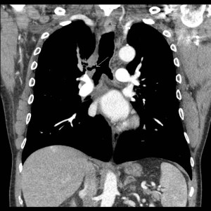 Coronal CT scan of the chest shows an accessory bronchus arising from the right lateral wall of the trachea (arrow) a few centimeters above the level of the carina.