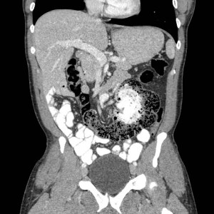Coronal CT of the abdomen and pelvis with oral and IV contrast reveals a markedly dilated stool filled cecum on the left side of the abdomen. The right lower quadrant of the abdomen is filled with small bowel loops. 