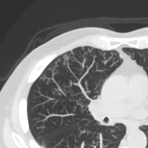 Axial maximum intensity projection (MIP) of the chest in lung windows shows numerous branching opacities predominately in the periphery of the lung parenchyma with a classic "Tree in Bud" pattern. 