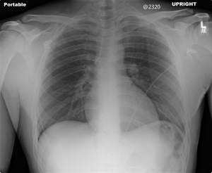 Frontal bedside (AKA: portable) chest radiograph, which is normal. Notice the cardiac silhouette may be misinterpreted as enlarged. 