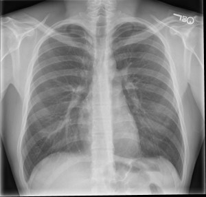 Frontal (PA) radiograph of the chest for comparison. Notice the cardiac silhouette appears smaller compared to the first image.