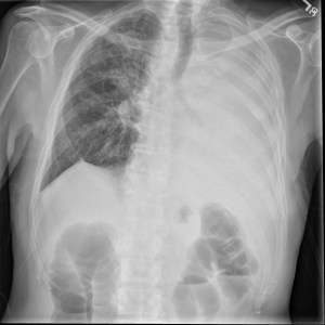 Frontal radiograph of the chest reveals complete opacification of the left hemithorax with deviation of the trachea to the left.