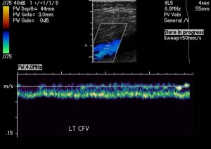 Doppler color ultrasound of the left common femoral vein with waveform.