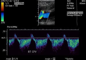 Doppler color ultrasound of the right common femoral vein.