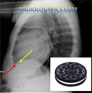 Pericardial effusion: Lateral radiograph of the chest demonstrating the pericardial fat (yellow line) and epicardial fat (red line) with opaque density separating them, indicating pericardial effusion. See oreo cookie for comparison. 
