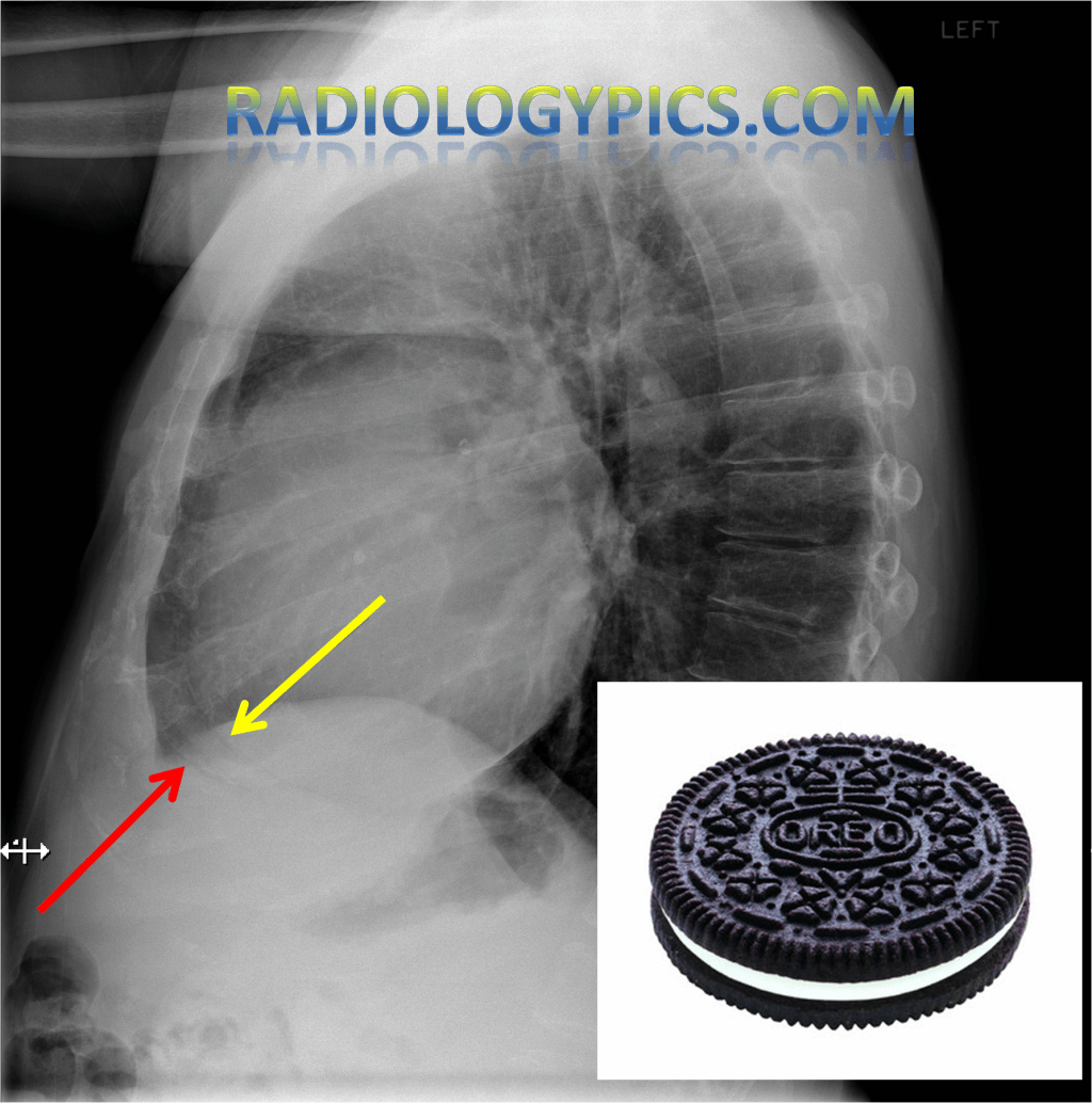 Pericardial Effusion – The Oreo Cookie&nbsp;Sign