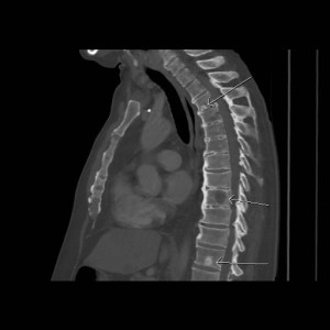 Sagittal CT of the thorax in bone windows shows multiple sclerotic and lytic foci within the thoracic spine vertebral bodies (arrows). 