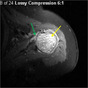 Axial fluid sensitive MRI of the left shoulder reveals marked heterogenous hyperintensity within the left humeral head (yellow arrow). A complex joint effusion is present within the anterior recess (green arrow). This is osteosarcoma of the left humerus.