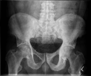 Frontal radiograph of the pelvis shows marked sclerosis of the sacroiliac joints, as well as the iliac bones, left greater than right (correlating with the bone scan findings). Additionally, there is severe osteoarthrosis of the hip joints, with joint space narrowing and remodeling of the femoral heads. 